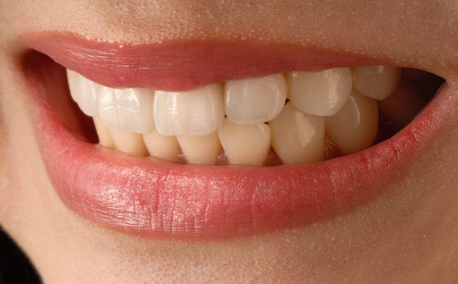 porcelain-veneers